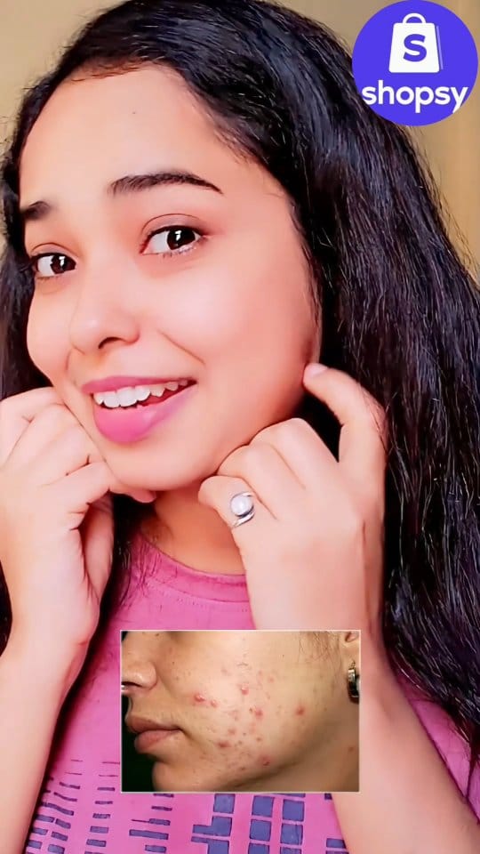 Comment for "Link "✨️
#acne #pimples #acnetreatment #beautytips #acneskincare #viralvideos #skincare #skin 
[ acne,skincare, beautytips, pimples, shopsy]