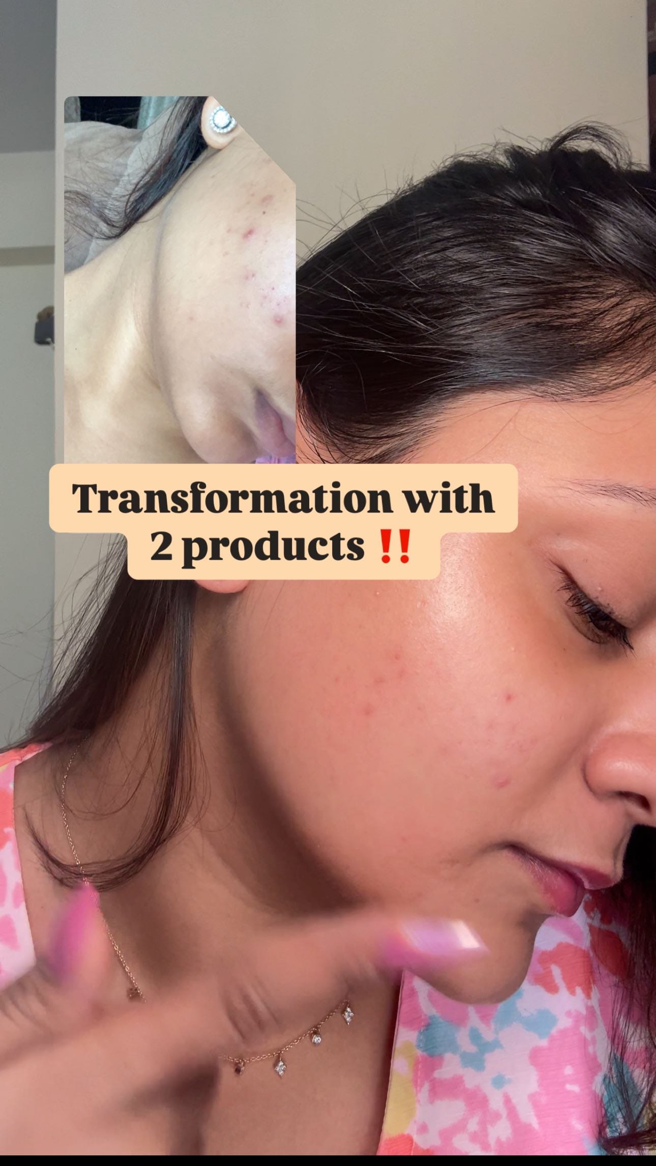 Comment “ SKIN “ to get the links in your DM today ! 
( pigmentation , dark spots , duo , skincare products, brightening serum , vitamin C , acne prone , acne marks , retinol pads , toner pads , collagen pads )