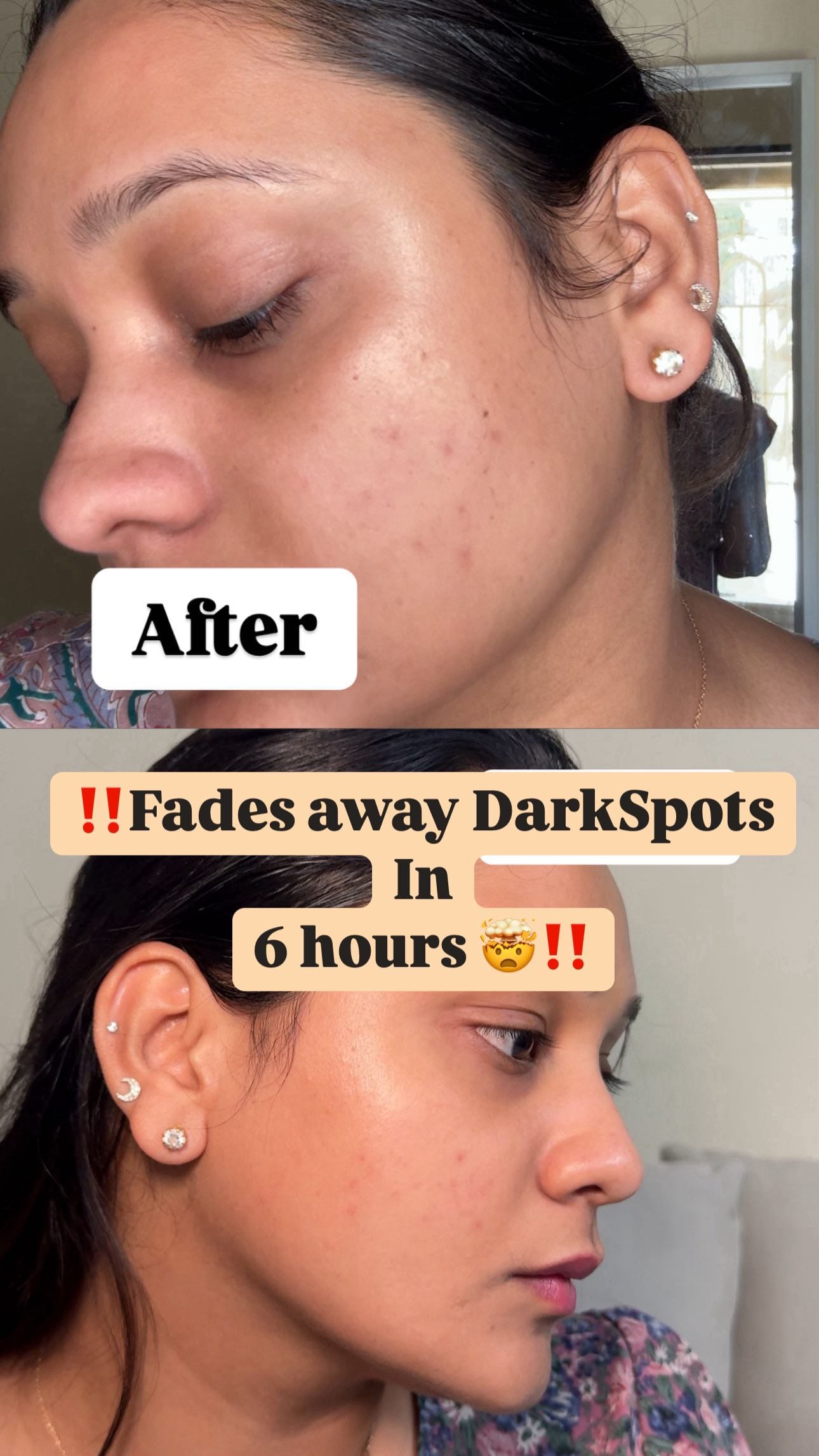 Comment “PATCH” to get the link in your DM ! 
These patches claim to work on surfaced dark spots ! They are made with 350 micro points ( it’s like micro needling ) honesty , only first few seconds you feel the tingling feel and the rest you don’t feel anything. 
Key ingredients - Niacinamide, Vitamin C & Gallic Acid. 
I’ve used this on the old spot ( not very old ) may be it isn’t effective but on a new spot it might work. However , reducing the spot in 6 hours is kinda big claim ! 
I haven’t seen any significant great changes at all ! 
💰 ₹599/- for 4 patches ! 
Would you try ? 
( invisible patches , microneedle patch , Indian brand , reduces Darkspots in 6 hours , conscious chemist ; purchased patch , review , dark spots, )