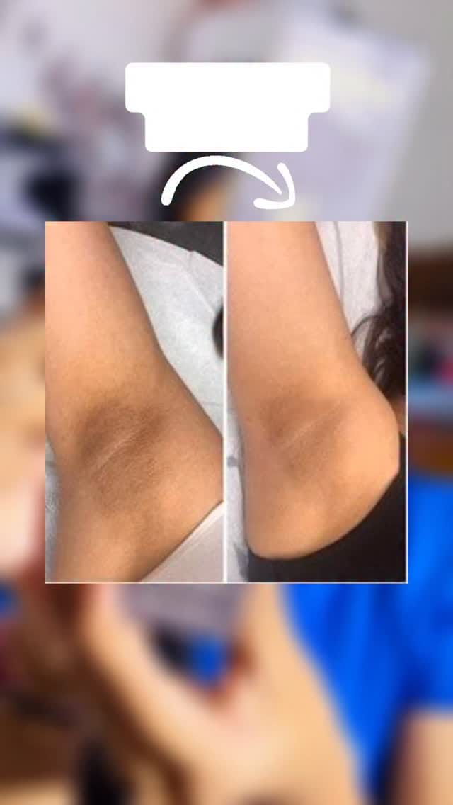 Dark underarms? Not anymore 💫
In just 2 weeks, Asaya Underarm Spray visibly reduced darkness, odor & pigmentation — giving smoother, brighter underarms you’ll actually feel confident showing off 💖
This isn’t my transformation… but it can be yours! 🌸
Say hello to freshness, brightness & confidence every day with Asaya Underarm Spray 💧
@worldofasaya 
.
.
[
Asaya Underarm Spray, Asaya Underarm Brightening Spray, Underarm Spray for Dark Underarms, Underarm Brightening Spray, Underarm Whitening Spray, Underarm Pigmentation Removal, Dark Underarm Treatment, Underarm Care Product, Underarm Odor Control Spray, Asaya India, Underarm Lightening Spray, Bright Underarms Remedy, Skincare for Underarms, Underarm Whitening Solution, Underarm Pigmentation Treatment, Even Tone Underarms, Body Care Routine for Women, Underarm Spray Review, How to Remove Dark Underarms, Best Product for Dark Underarms, Dark Underarm Solution, Underarm Brightening, Underarm Care Routine, Underarm Transformation, Underarm Care Essentials, Body Care Routine, Underarm Pigmentation, Bright Underarms]
.
.
#AsayaUnderarmSpray #fyp #explorepage #explore #foryoupage #skincare #ugccreator #fypシ 
#DarkUnderarmSolution
#UnderarmBrightening
#UnderarmCareRoutine
#UnderarmTransformation
#UnderarmCareEssentials
#BodyCareRoutine
#UnderarmPigmentation
#AsayaIndia
#BrightUnderarms