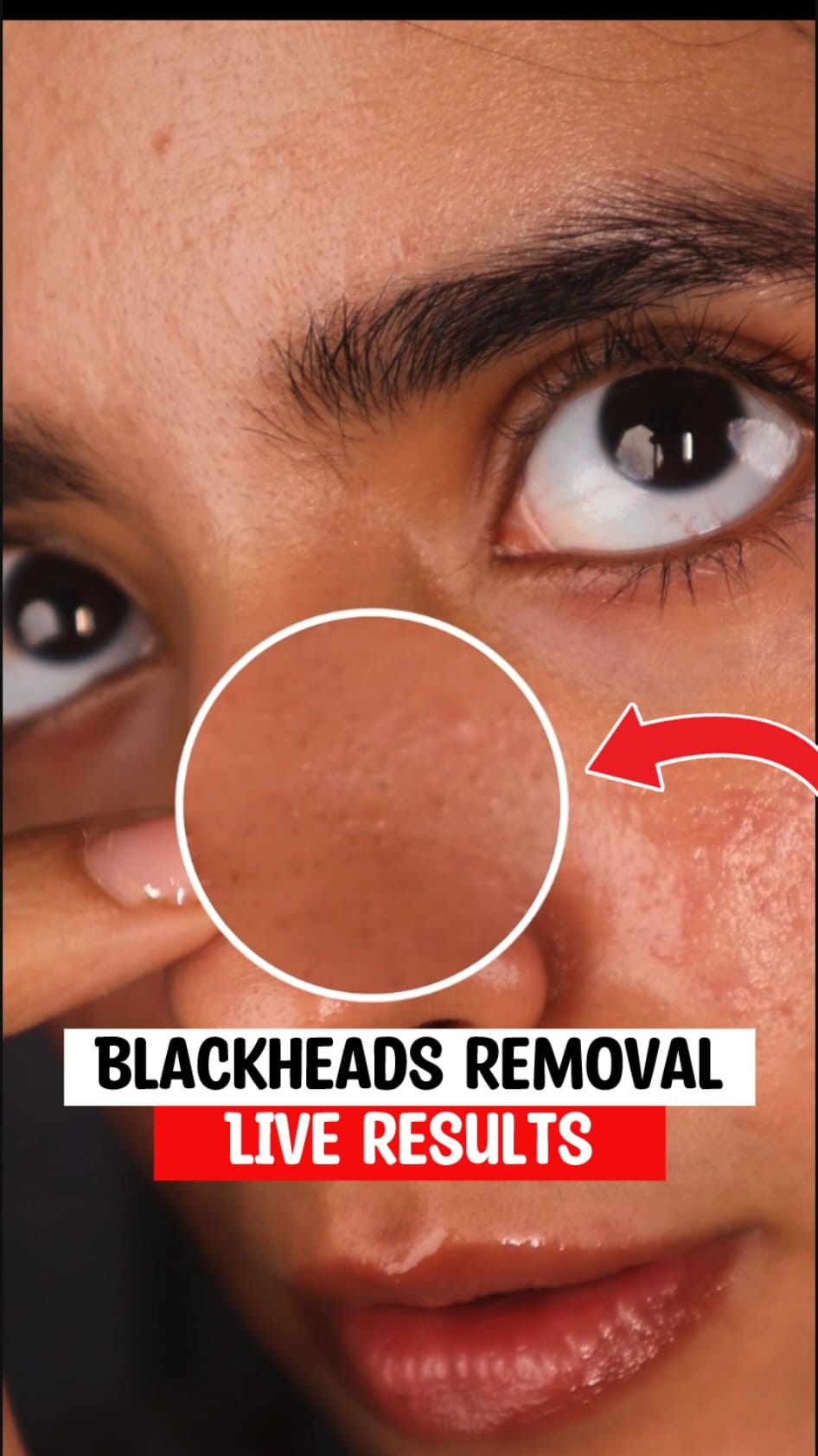 Blackheads removal process 
.
.
.
.
.
.
.
[blackheads removal, whiteheads treatment, nose blackheads, peel off mask, clogged pores, exfoliate skin, blackhead scrub, pore cleanser]