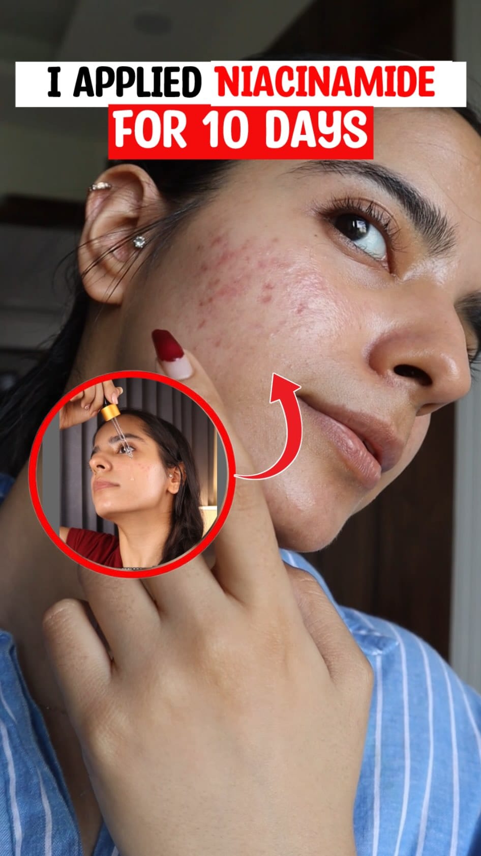 This is what happened when I applied Niacinamide for 10days 
.
.
.
.
.
.
.
[niacinamide serum, niacinamide for skin, best niacinamide, niacinamide benefits, niacinamide glow, niacinamide acne, niacinamide pores, niacinamide dark spots]