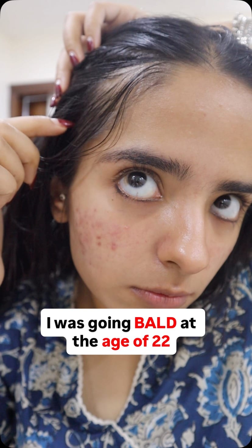 Comment to get the link 
This is how my hair thinning got controlled! 
The baby hairs you see? Not so baby anymore 
.
.
.
.
.
[hair growth serum, hairfall solution, hair regrowth, best hair serum, stop hairfall, grow hair fast, hair thinning treatment, anti hairfall serum, regrowth serum, baby hair growth]